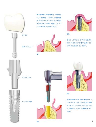 インプラント治療とは？